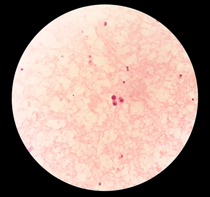 Ascetic fluid cytology, Malignant cells, Metastatic adenocarcinoma