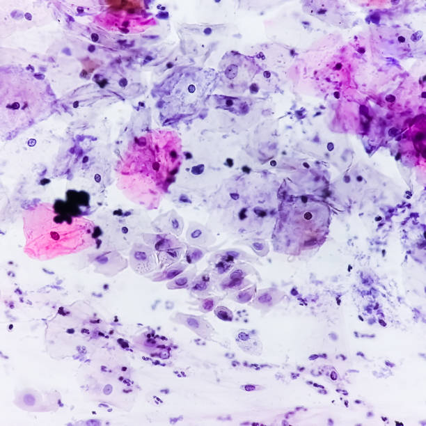 istock Photomicrograph of Paps smear: Inflammatory smear with HPV related changes. Cervical cancer. SCC 1870303151