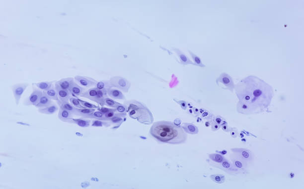 istock Photomicrograph of Paps smear: Inflammatory smear with HPV related changes. Cervical cancer. SCC 1870303658