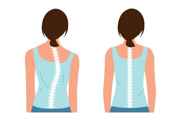 Good posture and bad posture. Good posture and bad posture. Chiropractic before after image. Scoliosis.Woman's body and backbone. kyphosis stock illustrations
