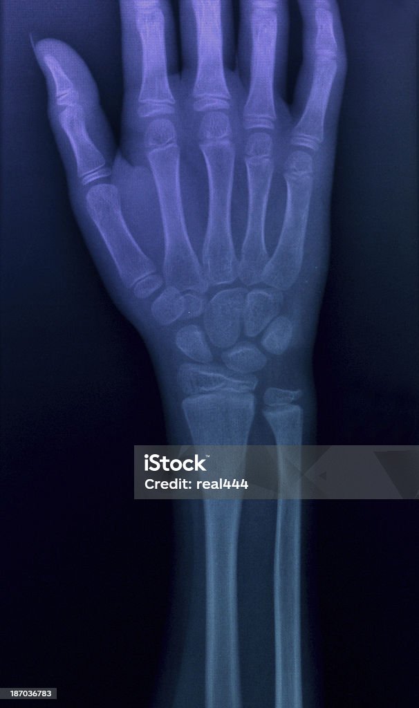 Immagine a raggi X mani - Foto stock royalty-free di Anatomia umana