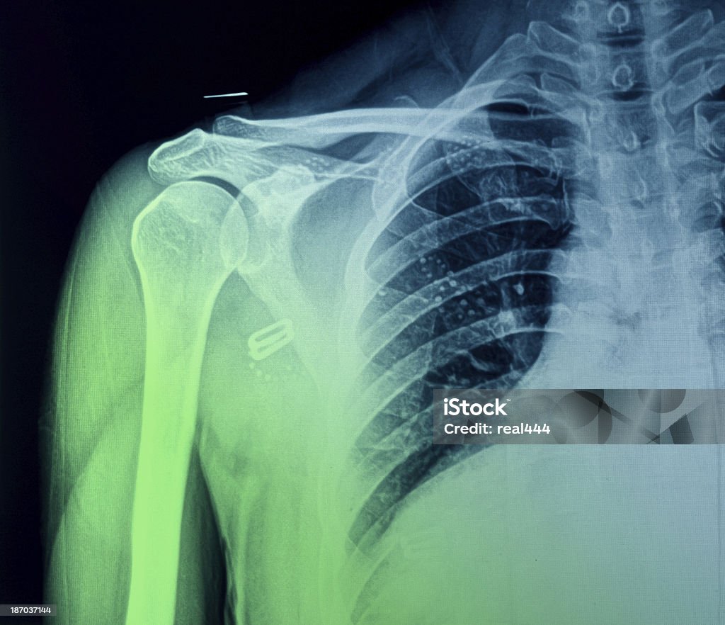 Zdjęcie rentgenowskie klatki piersiowej - Zbiór zdjęć royalty-free (Badanie lekarskie)