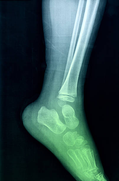imagem de raios x do pé. - bending human foot ankle x ray image - fotografias e filmes do acervo