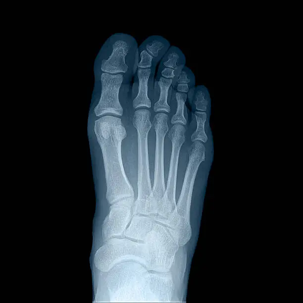 Photo of x-ray man's right foot - top view