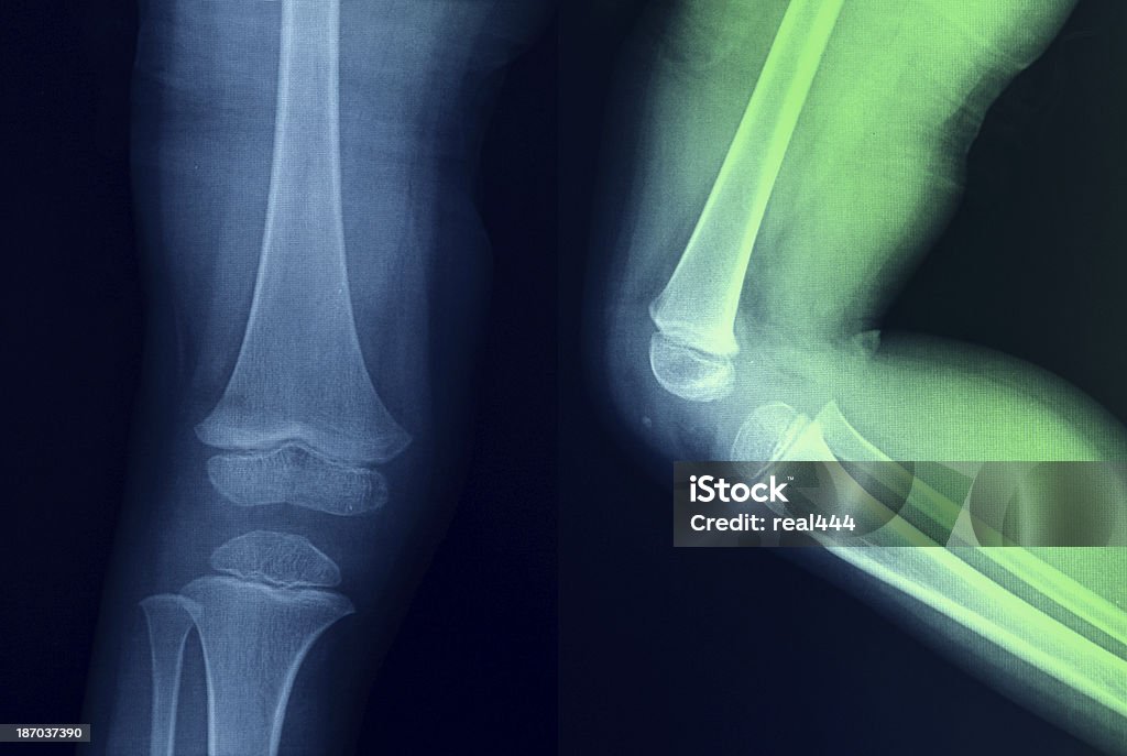 Genou humain anatomie X-Ray Os de la jambe - Photo de Anatomie libre de droits