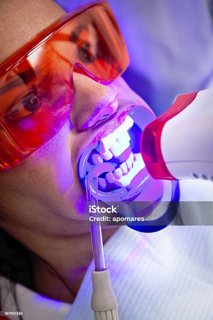 Tratamento de clareamento dental luz - Foto de stock de Adulto royalty-free