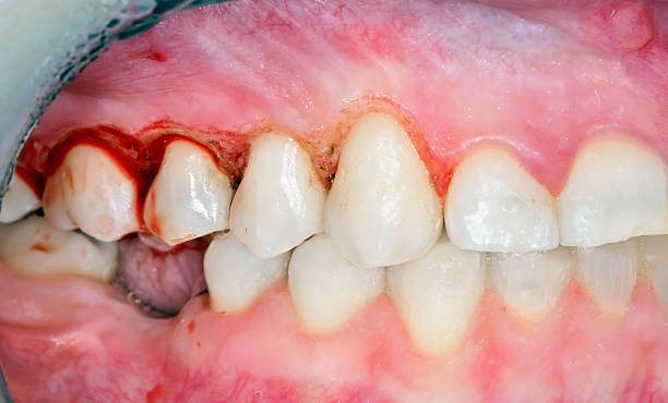Gingivoplasty Gingivoplasty procedure . Selective focus. gingivoplasty stock pictures, royalty-free photos & images