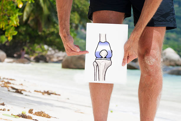 Total knee replacement Drawing of a total knee endoprosthesis (KEP). Please note: the patella doesn`t have to be replaced in most cases, that`s why there is an "original" patella in the drawing here. Lots of copy space. artificial knee photos stock pictures, royalty-free photos & images