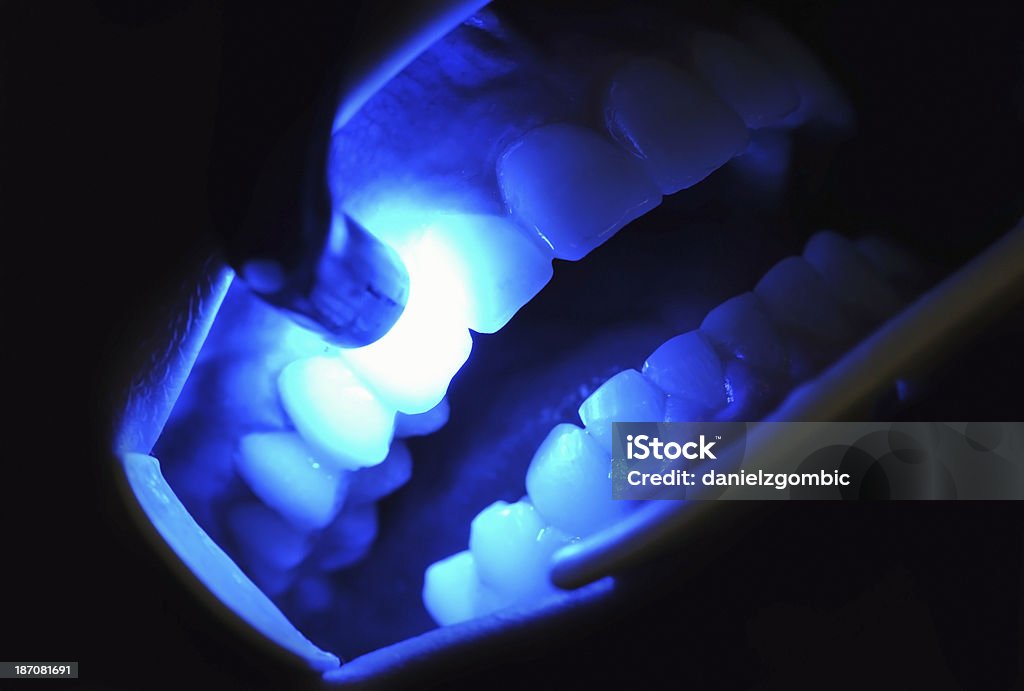 Zahnärztlichen Behandlung - Lizenzfrei Laserlicht Stock-Foto