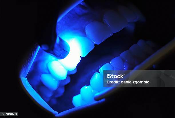 Zahnärztlichen Behandlung Stockfoto und mehr Bilder von Laserlicht - Laserlicht, Laserskalpell, Zahnaufhellung