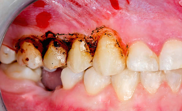 Gingivoplasty Gingivoplasty procedure . Selective focus. gingivoplasty stock pictures, royalty-free photos & images