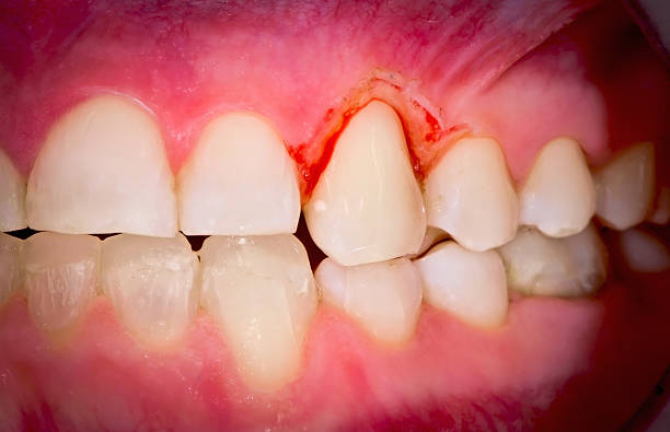 Gingivoplasty Gingivoplasty procedure . Selective focus. gingivoplasty stock pictures, royalty-free photos & images