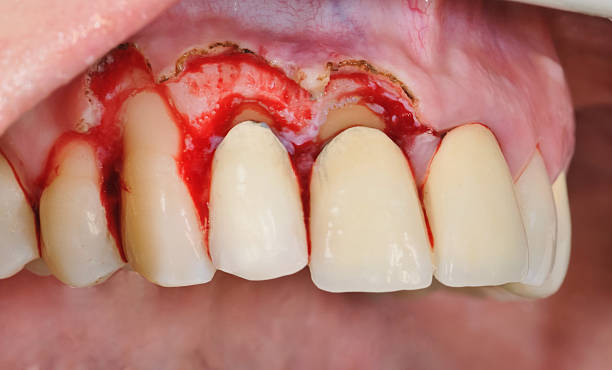 Gingivoplasty procedure Gingivoplasty procedure . Selective focus. gingivoplasty stock pictures, royalty-free photos & images