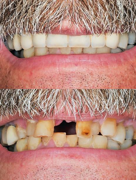 prima & dopo il sorriso design - toothless smile foto e immagini stock