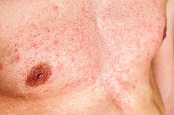 男性のお肌にアレルギーの感染症も含むボディ - angioedema ストックフォトと画像