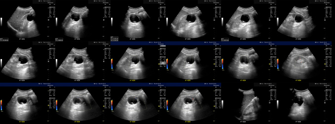 Abdominal ultrasound that indicates an anechoic (renal) cyst that measures 4.9 x 4.7 x 4.4 cm at the lower pole of the right kidney. It contains an internal septation with a focal calcification that measures 3mm in thickness (Bosniak II-F).  It contains no nodular or vascularized components.  These individual sections of this composite are the original un-tinted ultrasound images.  All personal information has been removed.