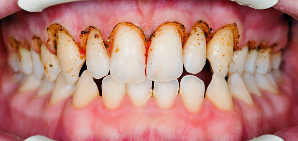 Gingivoplasty Gingivoplasty procedure . Selective focus. gingivoplasty stock pictures, royalty-free photos & images