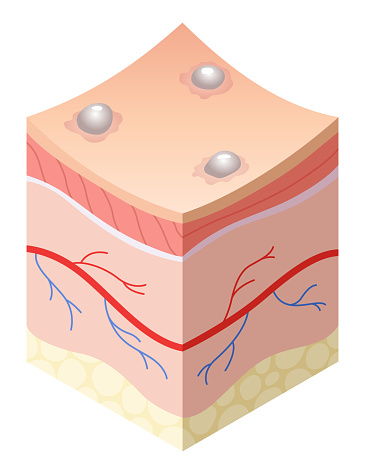 Skincare medical concept. Problems in cross-section of human skin horizontal layers structure. Anatomy illustrative model unhealthy layer of skin.