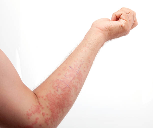 Red Skin Rash With Bumps, Shown here is a bumpy red skin rash on a men arm. scab arm stock pictures, royalty-free photos & images
