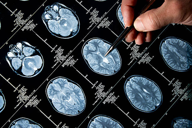 istock Pen pointing to MRI brain scan pictures 187272911