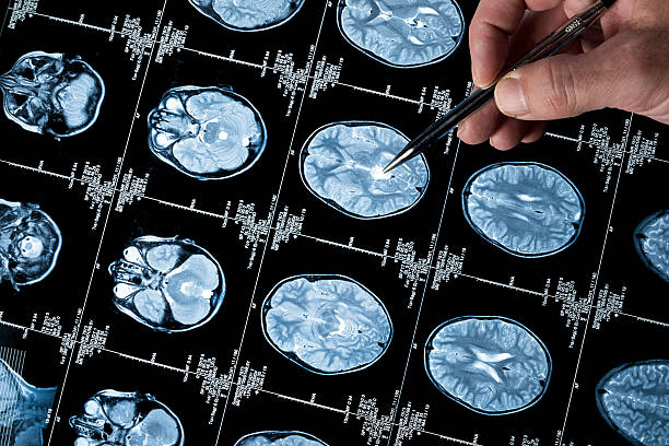 istock MRI Brain Scan of head and skull with hand pointing 187272933