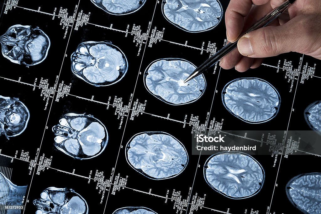 MRI cérebro exame da cabeça e crânio com Mão apontando - Foto de stock de Doença de Alzheimer royalty-free