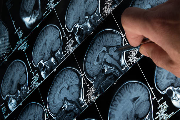 istock MRI Brain Scan of head and skull with hand pointing 187272937