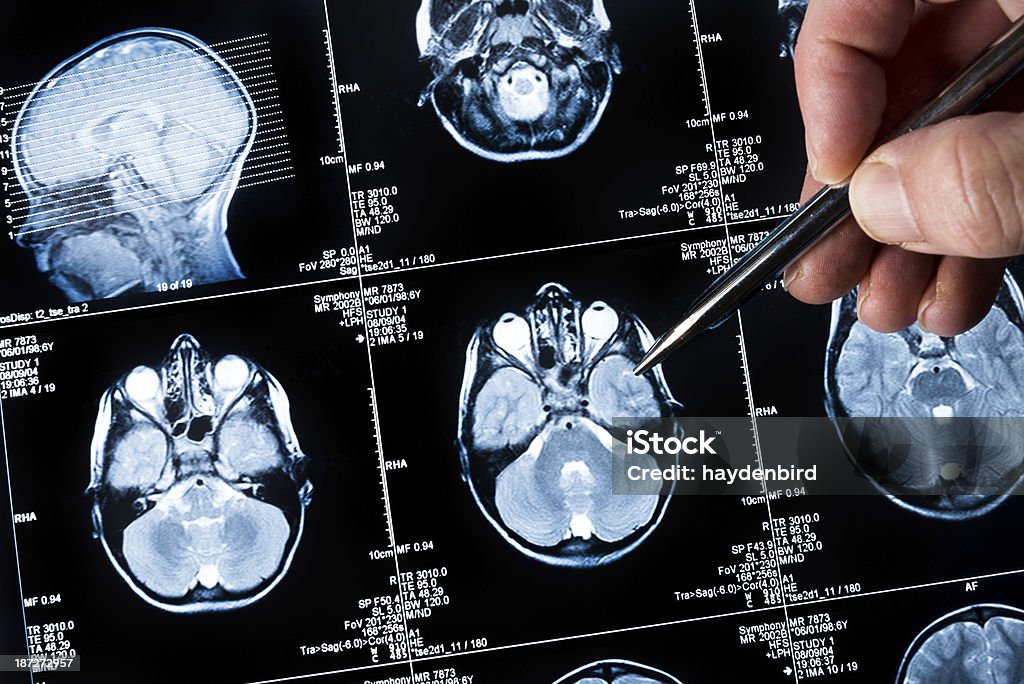 Brain scan being viewed by a doctor [b][url=http://www.istockphoto.com/file_search.php?action=file&lightboxID=6282716]
Click here for more cool MRI Images :)  [/url][/b]

[url=file_closeup?id=7160191][img]/file_thumbview/7160191/1[/img][/url] [url=file_closeup?id=15409319][img]/file_thumbview/15409319/1[/img][/url] [url=file_closeup?id=27746572][img]/file_thumbview/27746572/1[/img][/url] [url=file_closeup?id=7986493][img]/file_thumbview/7986493/1[/img][/url] [url=file_closeup?id=8613438][img]/file_thumbview/8613438/1[/img][/url] [url=file_closeup?id=7265522][img]/file_thumbview/7265522/1[/img][/url] [url=file_closeup?id=27748908][img]/file_thumbview/27748908/1[/img][/url] [url=file_closeup?id=27749249][img]/file_thumbview/27749249/1[/img][/url] [url=file_closeup?id=7265432][img]/file_thumbview/7265432/1[/img][/url] [url=file_closeup?id=9426571][img]/file_thumbview/9426571/1[/img][/url] [url=file_closeup?id=12380812][img]/file_thumbview/12380812/1[/img][/url]
[url=file_closeup?id=7159824][img]/file_thumbview/7159824/1[/img][/url] [url=file_closeup?id=11616487][img]/file_thumbview/11616487/1[/img][/url] [url=file_closeup?id=11616407][img]/file_thumbview/11616407/1[/img][/url] [url=file_closeup?id=8590061][img]/file_thumbview/8590061/1[/img][/url] [url=file_closeup?id=12930543][img]/file_thumbview/12930543/1[/img][/url] [url=file_closeup?id=27670520][img]/file_thumbview/27670520/1[/img][/url] [url=file_closeup?id=27670208][img]/file_thumbview/27670208/1[/img][/url] [url=file_closeup?id=27670358][img]/file_thumbview/27670358/1[/img][/url] [url=file_closeup?id=27670333][img]/file_thumbview/27670333/1[/img][/url] [url=file_closeup?id=27670247][img]/file_thumbview/27670247/1[/img][/url] [url=file_closeup?id=11998570][img]/file_thumbview/11998570/1[/img][/url] [url=file_closeup?id=27670426][img]/file_thumbview/27670426/1[/img][/url] [url=file_closeup?id=7986601][img]/file_thumbview/7986601/1[/img][/url] [url=file_closeup?id=34926176][img]/file_thumbview/34926176/1[/img][/url] Epilepsy Stock Photo