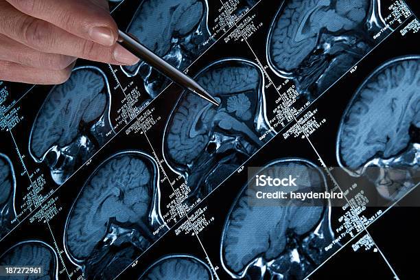 Mri Scan Des Kopf Gehirn Und Schädel Mit Hand Zeigt Stockfoto und mehr Bilder von Präfrontaler Cortex