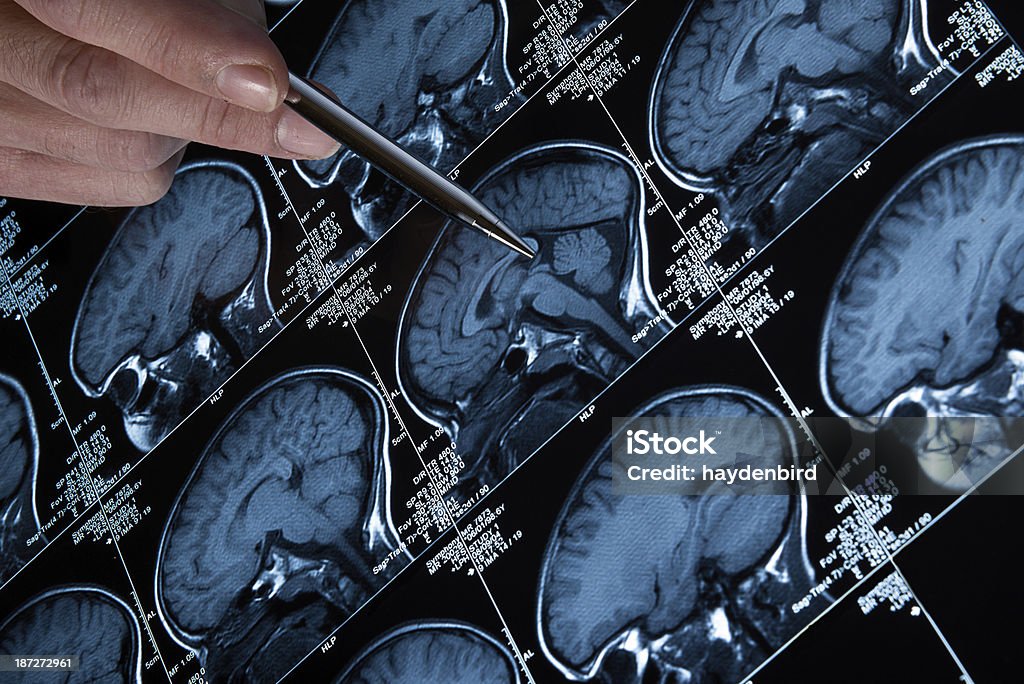 MRI 脳スキャンの頭とスカル、指を指す手 - 前前頭皮質のロイヤリティフリーストックフォト