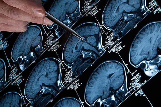 istock A person looking at an MRI brain scan 187272961