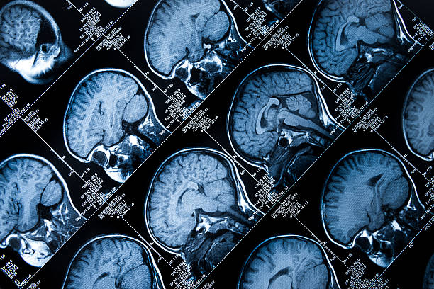istock MRI Brain Scan showing multiple images of head and skull 187272987