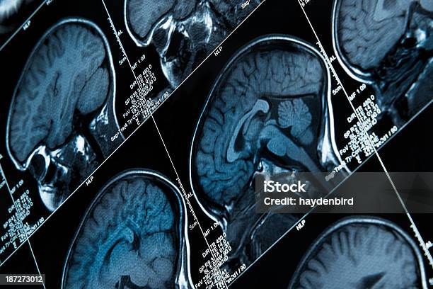 Mri는 뇌 스캔 표시중 여러 영상을 헤드 및 스컬 뇌전증에 대한 스톡 사진 및 기타 이미지 - 뇌전증, 전전두엽피질, CAT 스캔