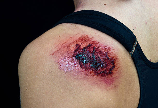 open wound on woman shoulder stock photo