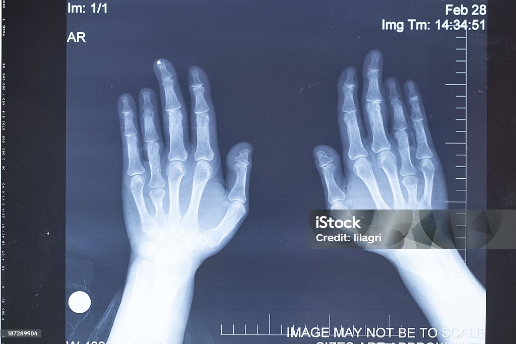 Mão de radiografia - Royalty-free Analisar Foto de stock