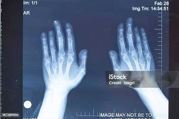 Mão De Radiografia - Fotografias de stock e mais imagens de Analisar - Analisar, Anatomia, Articulação humana