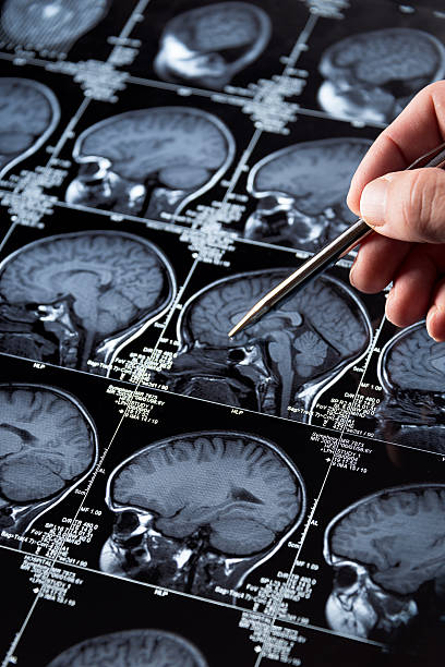 istock MRI Brain Scan of head and skull with hand pointing 187293466