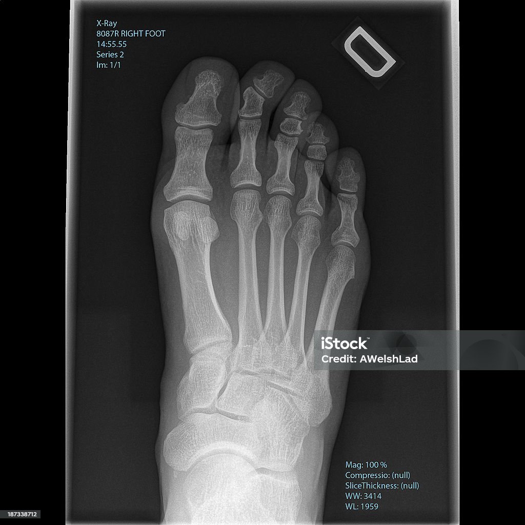 x-ray hombre de pie derecho de vista superior - Foto de stock de Afección médica libre de derechos