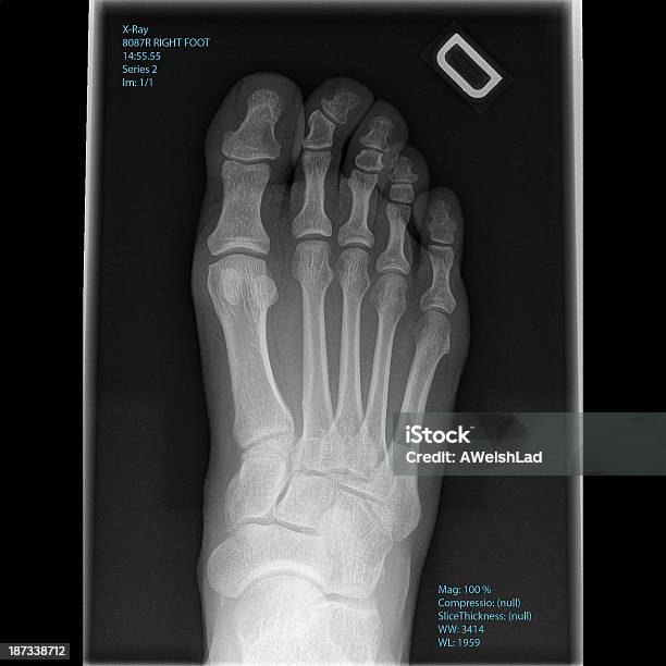 Xray Hombre De Pie Derecho De Vista Superior Foto de stock y más banco de imágenes de Afección médica - Afección médica, Anatomía, Articulación