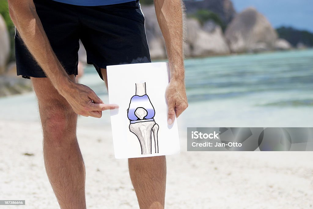슬관절 전치환술 (Total knee replacement - 로열티 프리 인공 무릎 스톡 사진