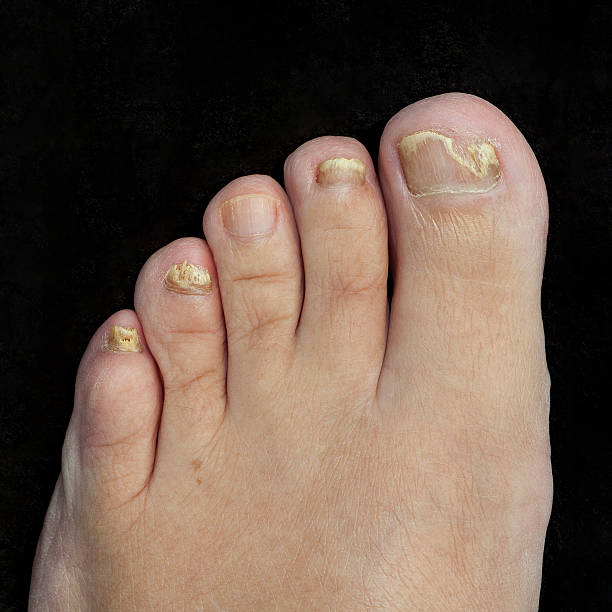 toenail fungus toenail fungus bed of nails stock pictures, royalty-free photos & images