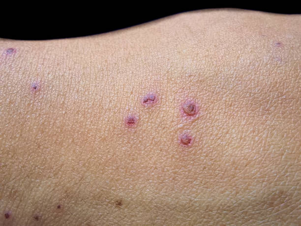 istock Itching skin lesions with scabs on the hand 1876391237