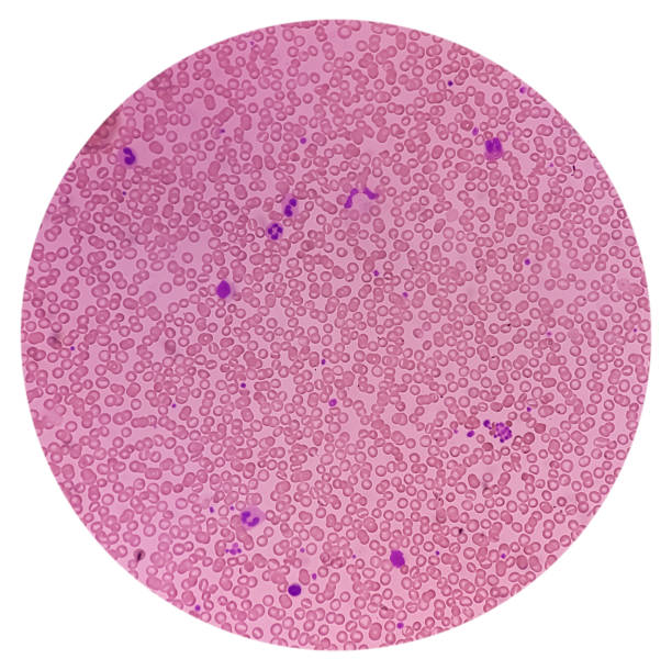 istock Bone marrow study, microscopically show megakaryocytes. Megakaryocytic hyperplasia. Thrombocytopenia. 1876439174
