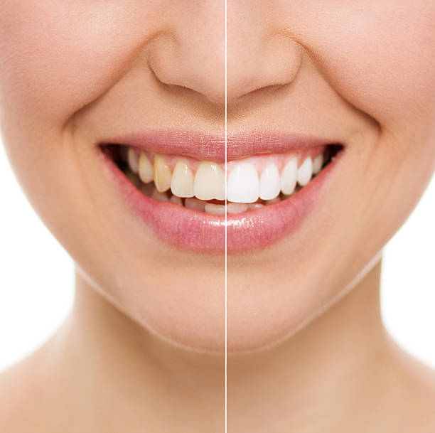 Dental care woman Before and after teeth bleaching or whitening treatment. Close-up of young Caucasian female's smile. human teeth stock pictures, royalty-free photos & images