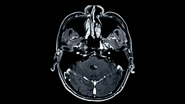 istock MRI brain scans axial view offer valuable insights into brain an 1876746872