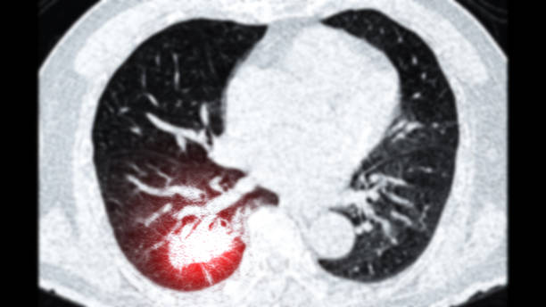 CT scan of Chest or lung  axial viewshowing lung cancer lung cancer . stock photo