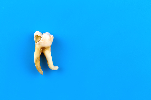 A real human tooth is affected by caries and with a curved root at an angle of almost 90 degrees
