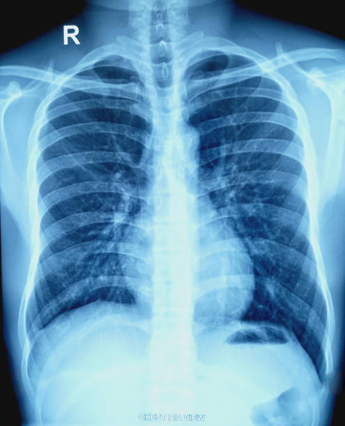 istock X-ray of human Chest. 1876972896