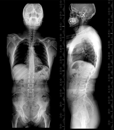 X-ray image of Whole human Spine comparison AP and Lateral view showing scoliosis of thoracic spine