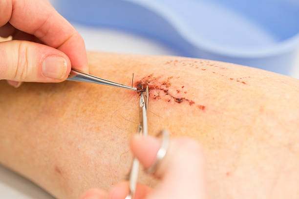 istock Nurse is removing stitches from a wound on patients leg 187864444